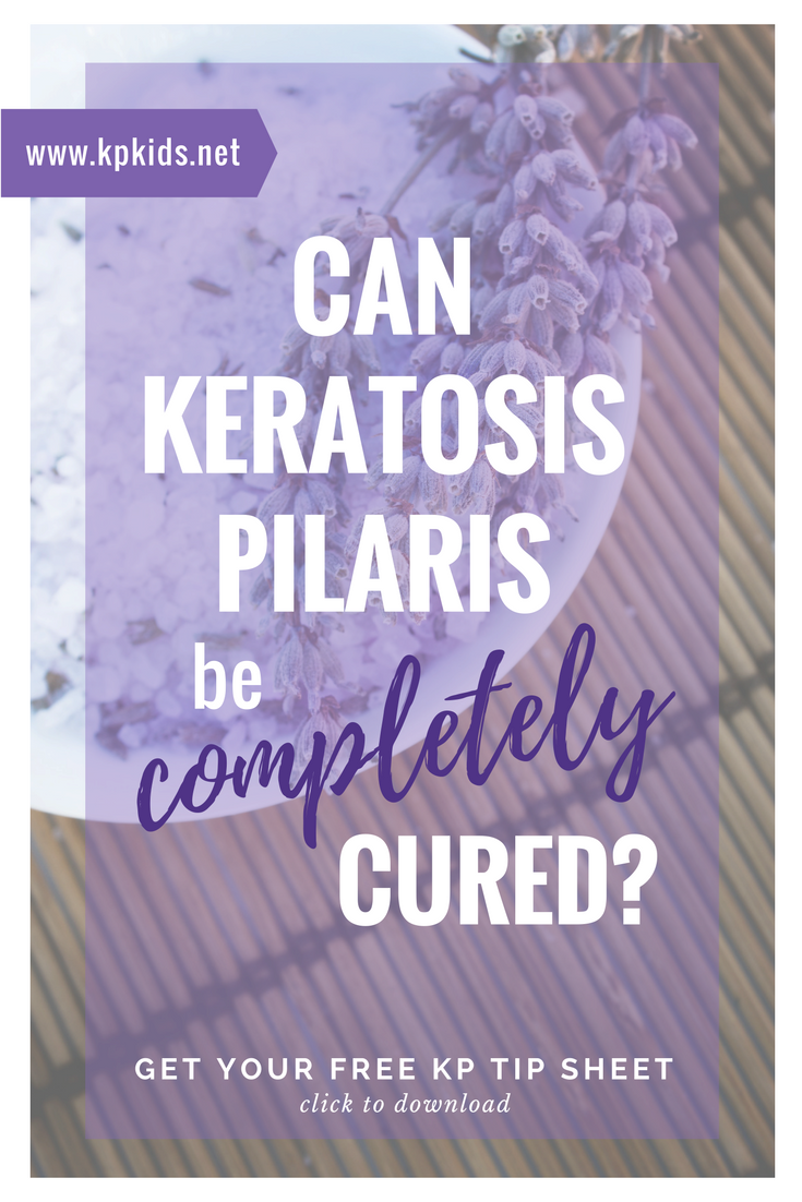 Can Keratosis Pilaris be Completely Cured? | KPKids.net