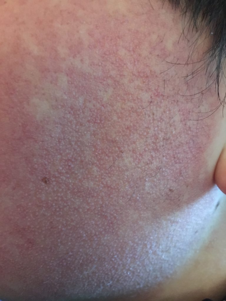 Kids With Keratosis Pilaris KPKids Kpkids kids-with-keratosis-pilaris-kpkids-kpkids