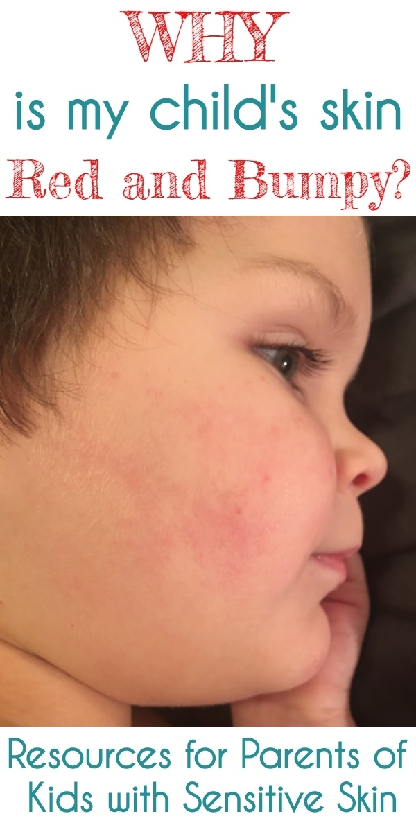 Red & Bumpy Skin: Sensitive Skin or Keratosis Pilaris in Toddlers & Children