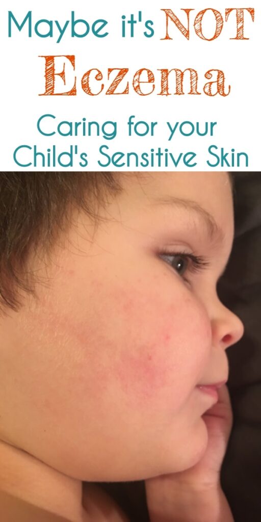 Keratosis Pilaris Condition, Treatments and Pictures for Children -  Skinsight