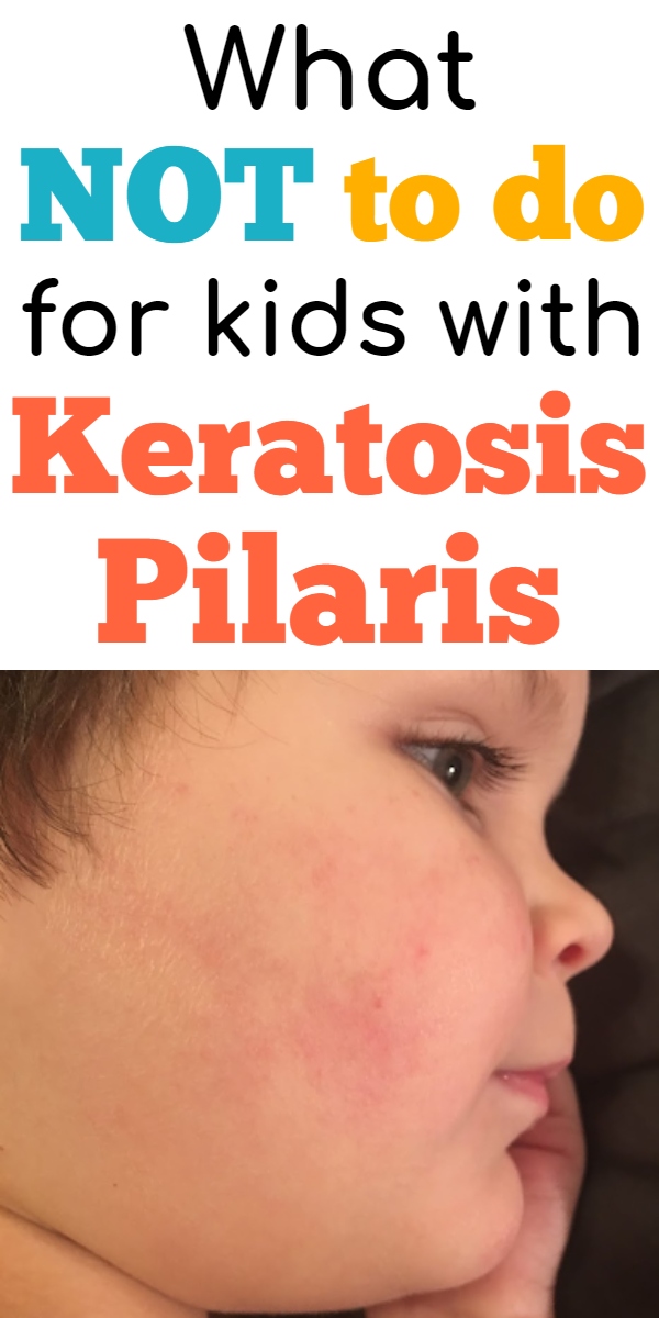 Keratosis Pilaris Treatment in Toddlers, Babies, & Kids