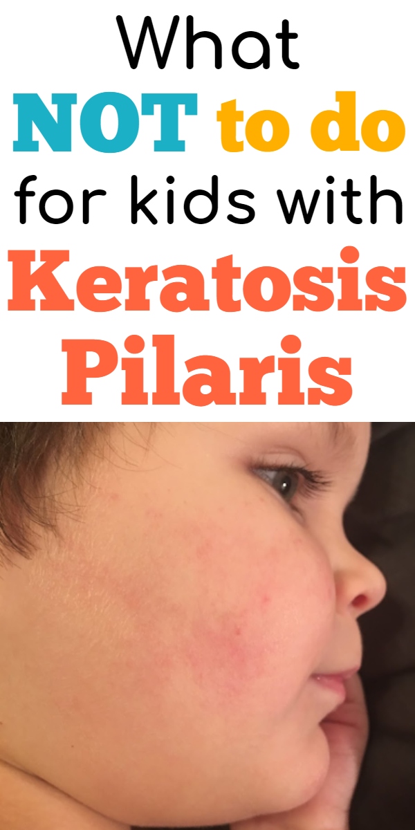 Keratosis deals pilaris face