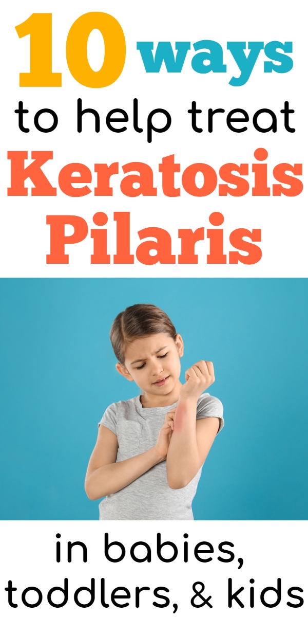 How to treat Keratosis Pilaris in toddlers, babies, & children